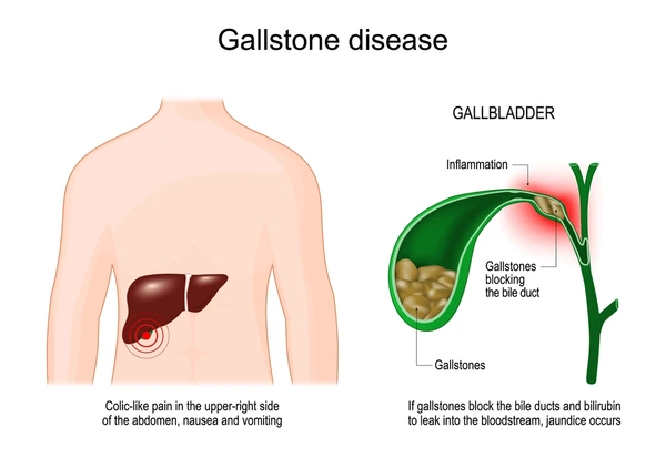 Risk factors for gallstone formation